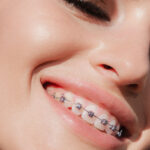 An Adult’s Guide to Getting Braces
